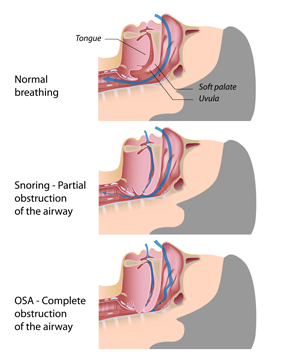 apnea